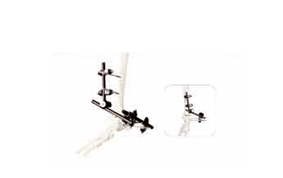 踝关节的桥接固定（HM-50109）